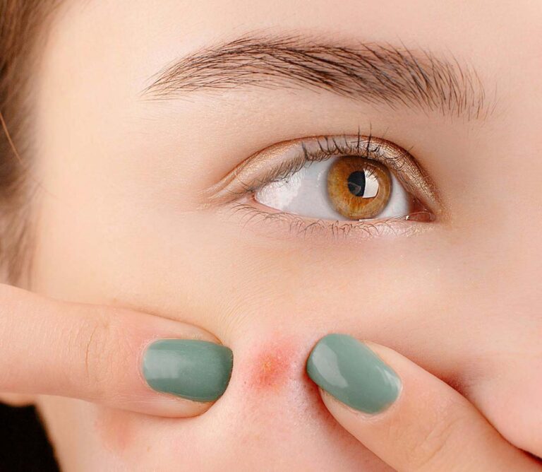 5 βασικές συμβουλές για την αντιμετώπισης της ακμής