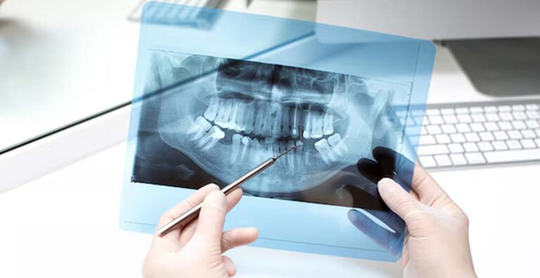 Γέφυρα δοντιών. Η λύση για ένα… ολοκληρωμένο χαμόγελο!