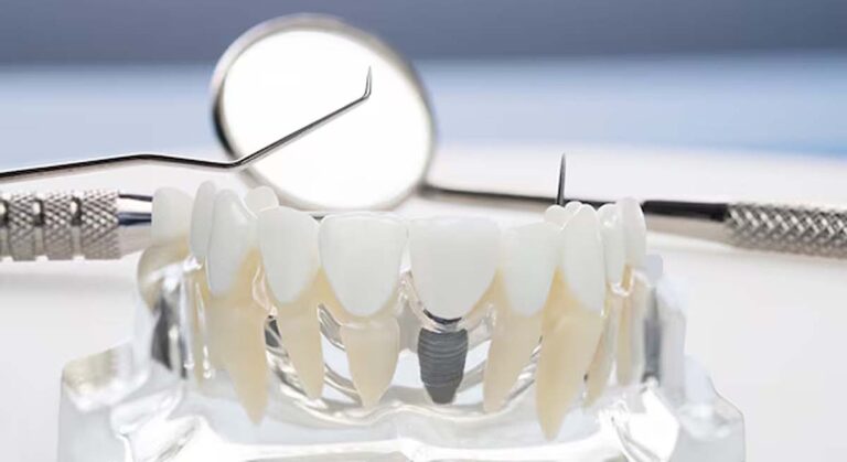 Γεφυρώστε τα κενά και αποκτήστε αυτοπεποίθηση με γέφυρες δοντιών!