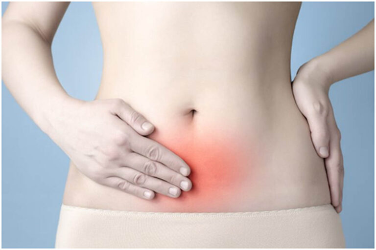 Ενδομητρίωση: Μια συχνή αλλά συχνά υποδιαγνωσμένη γυναικολογική πάθηση.